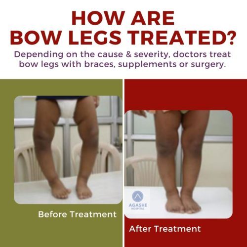 how are bow legs treated